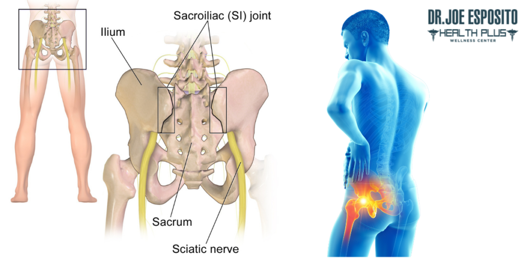 understanding-the-connection-can-hip-arthritis-cause-si-joint-pain